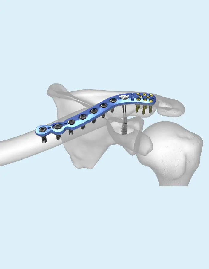 Bone Plate