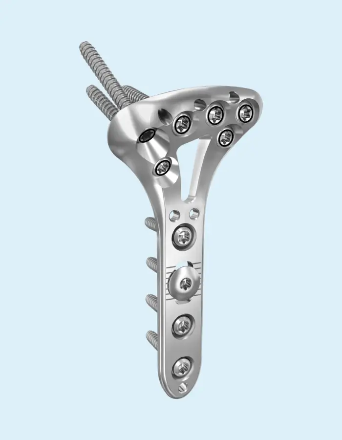 Locking Plate System
